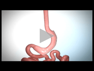 Sleeve gastrectomy