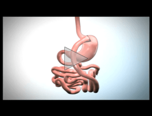 Roux en Y Gastric Bypass