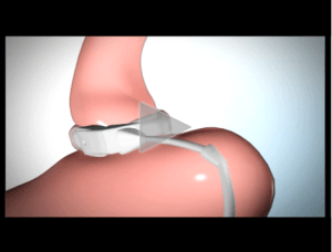 Laparoscopic Adjustable Gastric Band